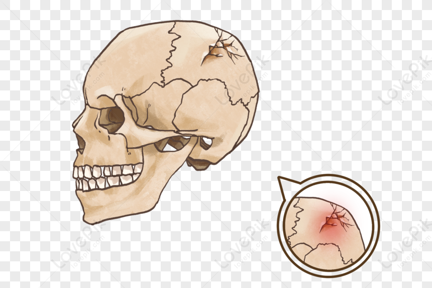 Череп разрыв. Паутинообразный перелом черепа. Вдавленный перелом черепа.