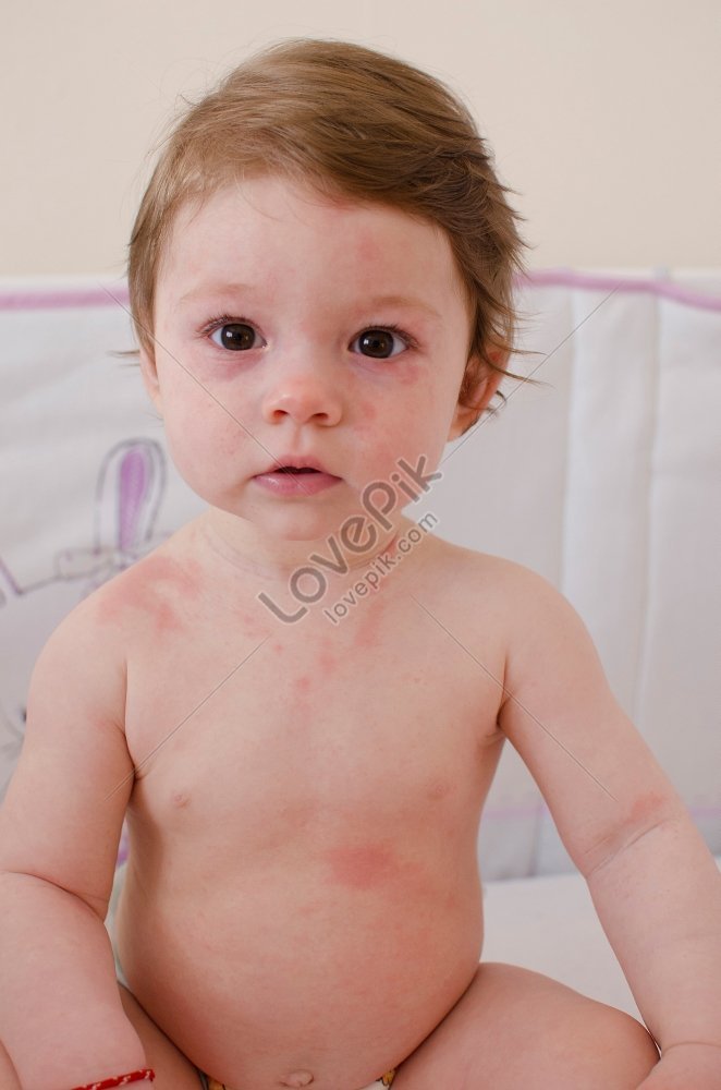 Foto Del Cuerpo De Una Niña Cubierta Con Sarpullido Cutáneo Por Roséola ...