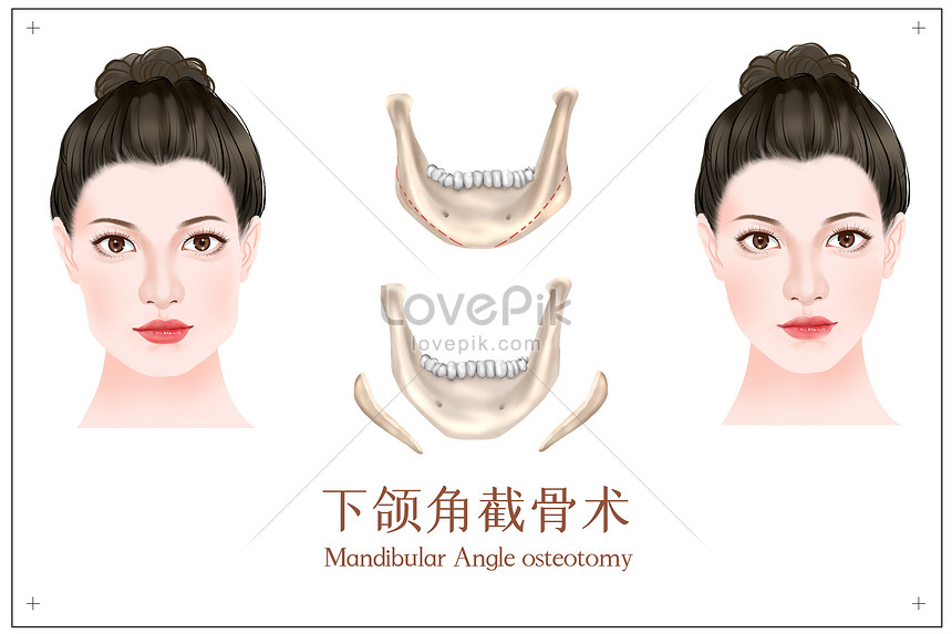 Mandibular angle osteotomy medical beauty illustration illustration ...