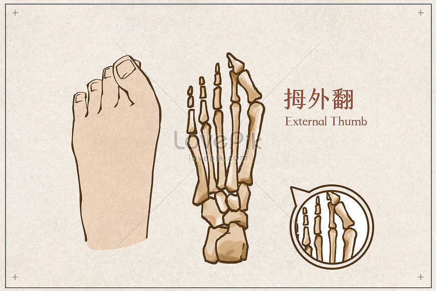 Hallux valgus illustration image_picture free download 401795629 ...