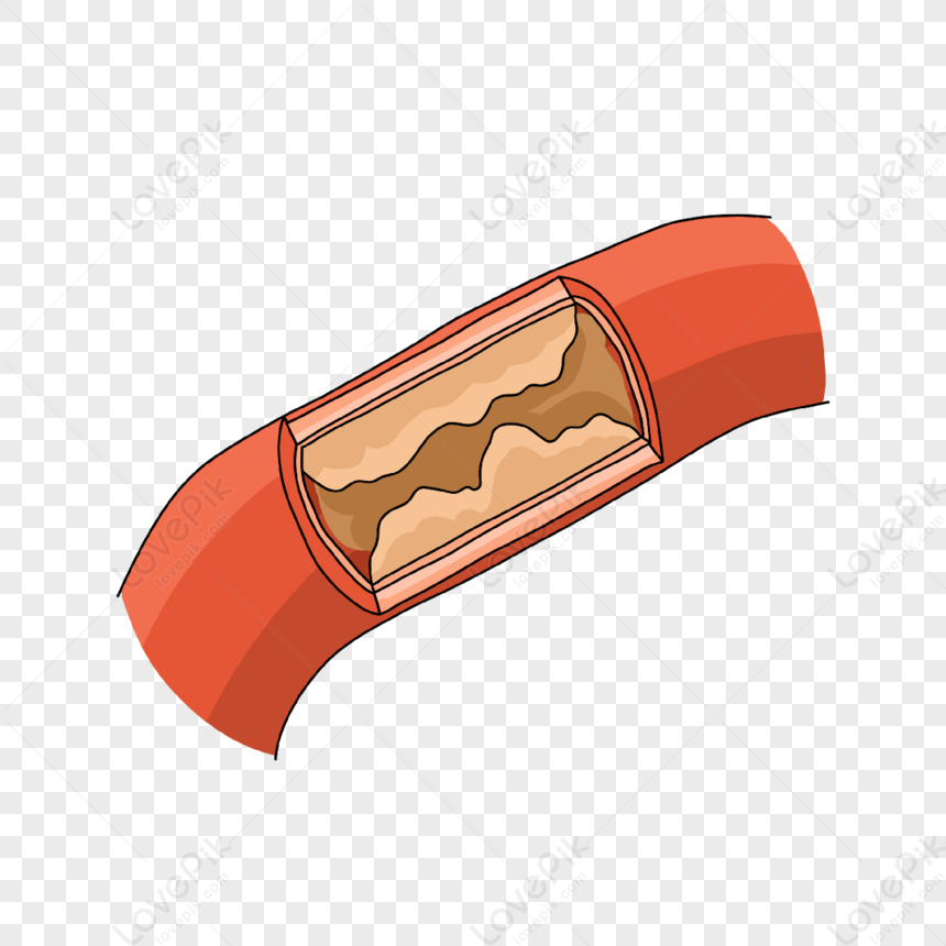 Cardiology Severely Blocked Blood Vessel Illustration,periodical ...